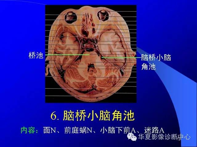 蝶鞍-脑室-脑池（高清+详细标注）