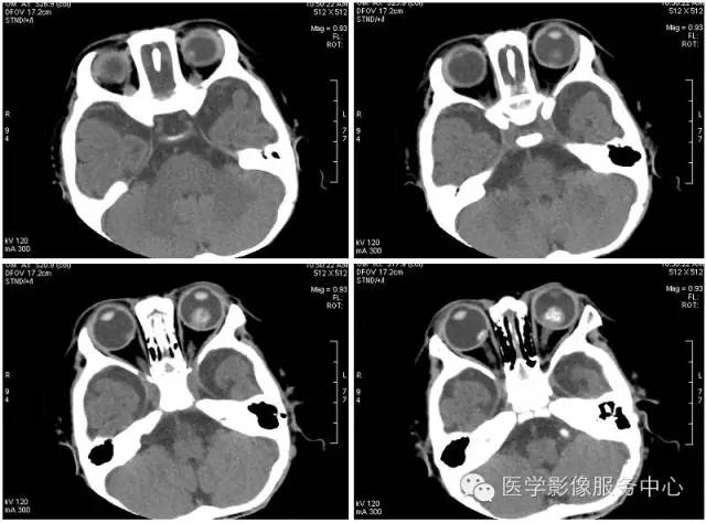 【病例】双侧视网膜母细胞瘤1例CT影像表现