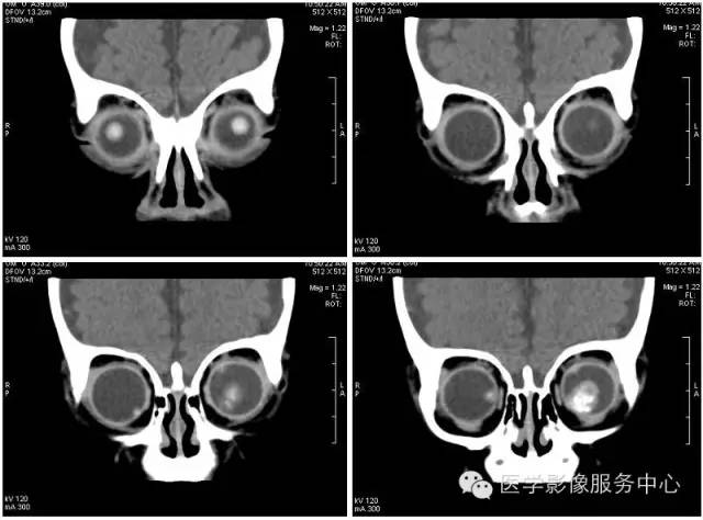【病例】双侧视网膜母细胞瘤1例CT影像表现 【病例】双侧视网膜母细胞瘤1例CT影像表现