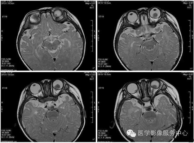 【病例】双侧视网膜母细胞瘤1例CT影像表现 【病例】双侧视网膜母细胞瘤1例CT影像表现
