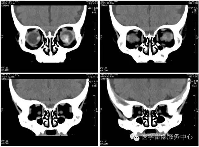 【病例】双侧视网膜母细胞瘤1例CT影像表现 【病例】双侧视网膜母细胞瘤1例CT影像表现