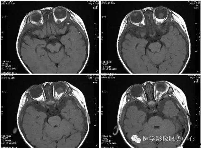 【病例】双侧视网膜母细胞瘤1例CT影像表现 【病例】双侧视网膜母细胞瘤1例CT影像表现