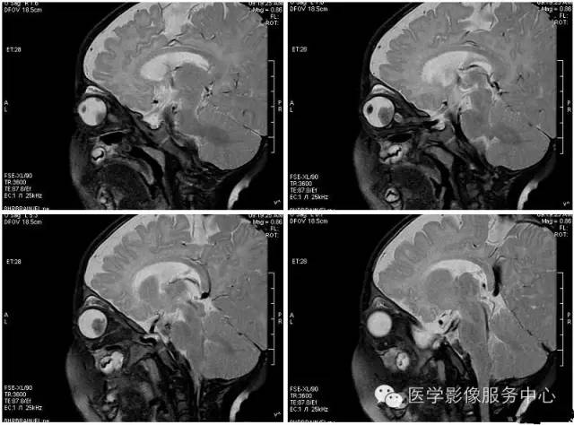 【病例】双侧视网膜母细胞瘤1例CT影像表现 【病例】双侧视网膜母细胞瘤1例CT影像表现