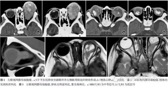 【病例】双侧视网膜母细胞瘤1例CT影像表现 【病例】双侧视网膜母细胞瘤1例CT影像表现