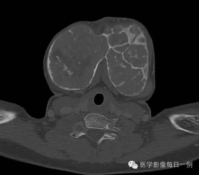 【病例】骨纤维异样增殖症1例CT影像表现 【病例】骨纤维异样增殖症1例CT影像表现