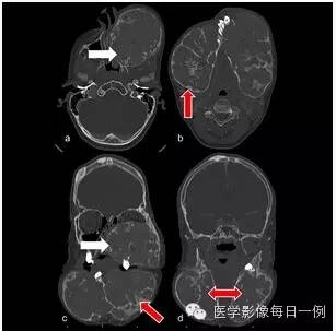 【病例】骨纤维异样增殖症1例CT影像表现
