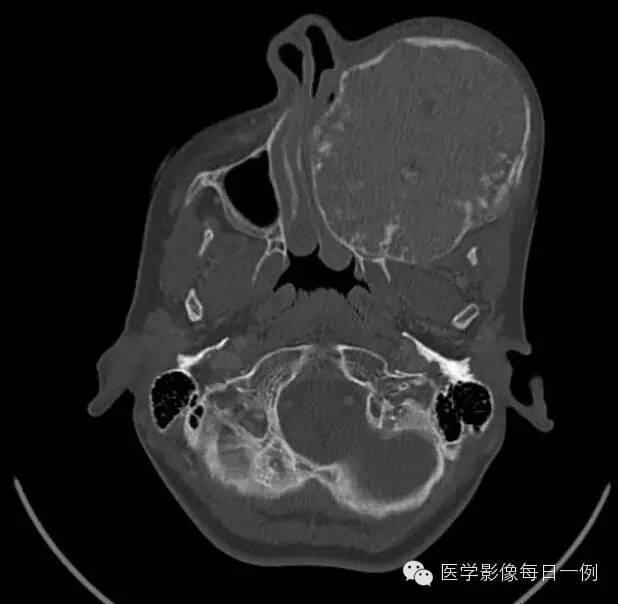 【病例】骨纤维异样增殖症1例CT影像表现 【病例】骨纤维异样增殖症1例CT影像表现