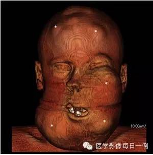 【病例】骨纤维异样增殖症1例CT影像表现 【病例】骨纤维异样增殖症1例CT影像表现
