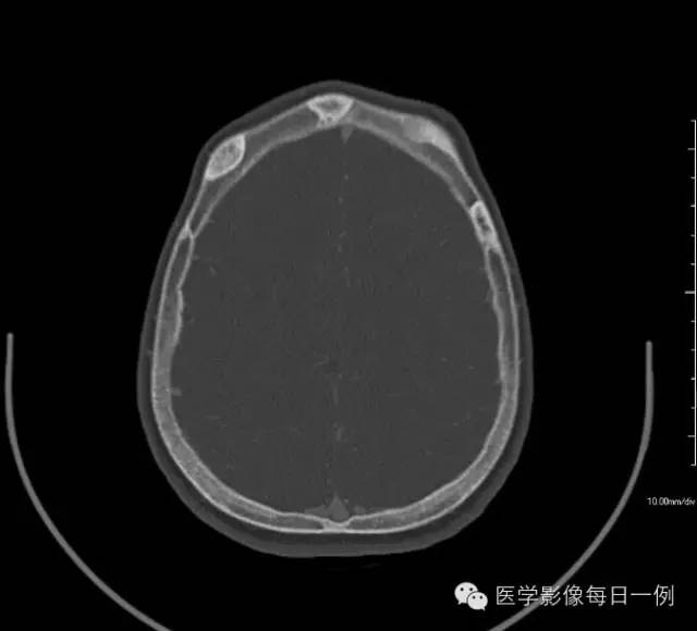 【病例】骨纤维异样增殖症1例CT影像表现 【病例】骨纤维异样增殖症1例CT影像表现