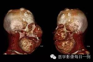 【病例】骨纤维异样增殖症1例CT影像表现 【病例】骨纤维异样增殖症1例CT影像表现