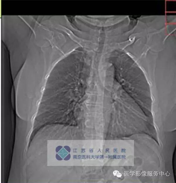 【病例】肺硬化性血管瘤1例CT影像表现 【病例】肺硬化性血管瘤1例CT影像表现