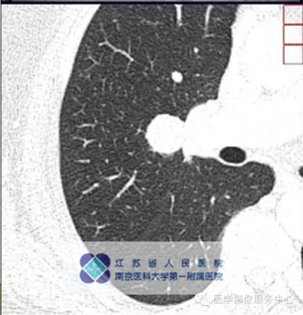 【病例】肺硬化性血管瘤1例CT影像表现