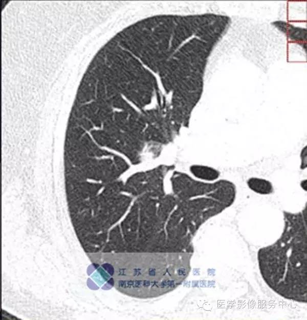 【病例】肺硬化性血管瘤1例CT影像表现 【病例】肺硬化性血管瘤1例CT影像表现
