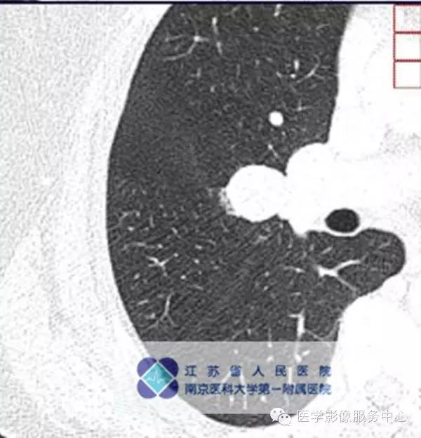 【病例】肺硬化性血管瘤1例CT影像表现 【病例】肺硬化性血管瘤1例CT影像表现