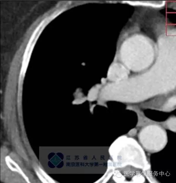 【病例】肺硬化性血管瘤1例CT影像表现 【病例】肺硬化性血管瘤1例CT影像表现