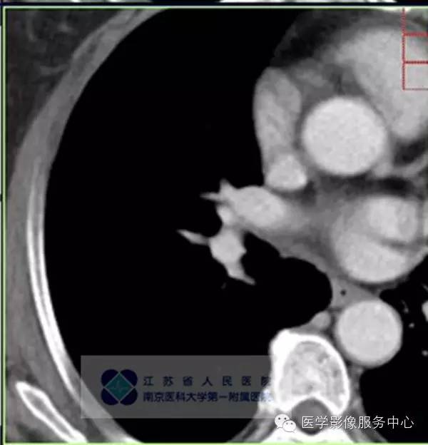 【病例】肺硬化性血管瘤1例CT影像表现 【病例】肺硬化性血管瘤1例CT影像表现
