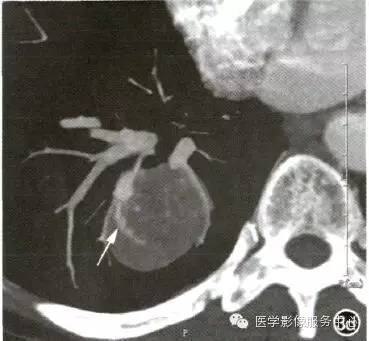 【病例】肺硬化性血管瘤1例CT影像表现 【病例】肺硬化性血管瘤1例CT影像表现