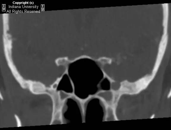 【病例】眼眶淋巴瘤1例CT影像表现 【病例】眼眶淋巴瘤1例CT影像表现