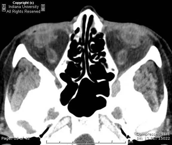【病例】眼眶淋巴瘤1例CT影像表现 【病例】眼眶淋巴瘤1例CT影像表现