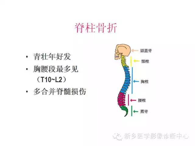 脊柱骨折分型