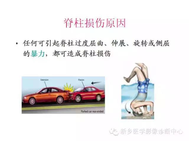 脊柱骨折分型 脊柱骨折分型