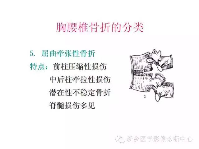 脊柱骨折分型 脊柱骨折分型