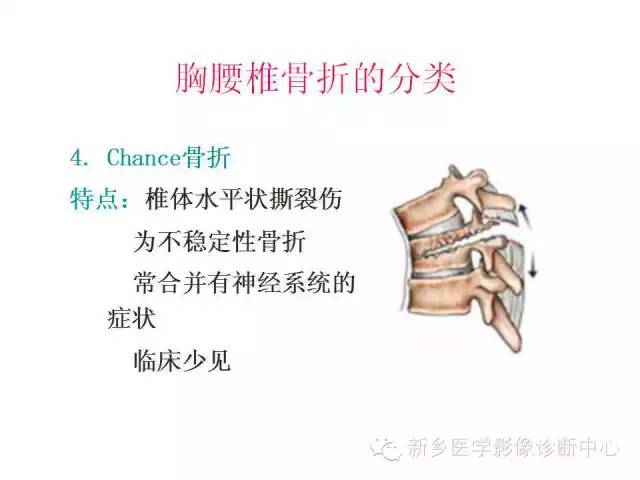脊柱骨折分型 脊柱骨折分型