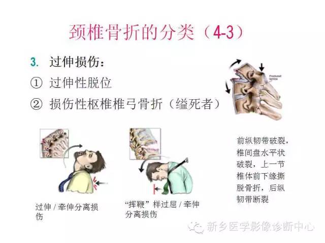 脊柱骨折分型 脊柱骨折分型