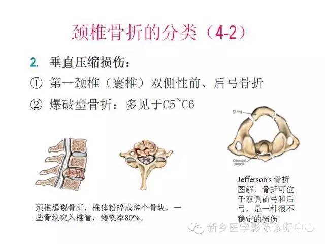 脊柱骨折分型 脊柱骨折分型