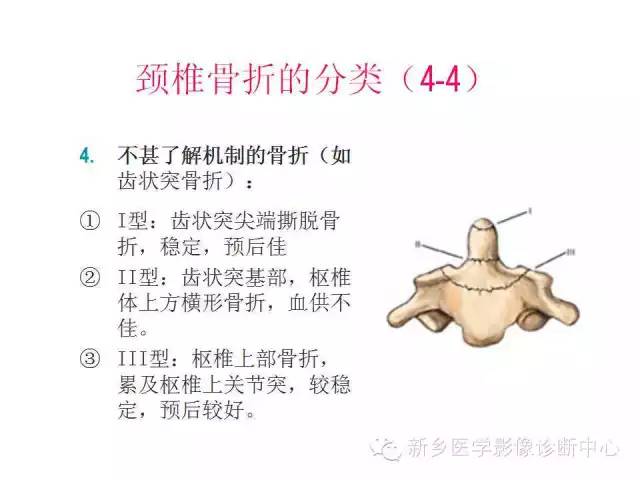脊柱骨折分型 脊柱骨折分型