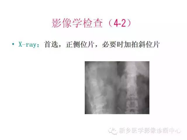 脊柱骨折分型 脊柱骨折分型