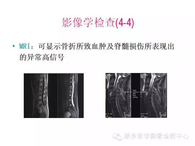脊柱骨折分型 脊柱骨折分型