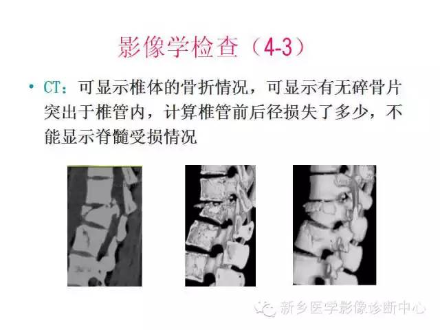 脊柱骨折分型 脊柱骨折分型