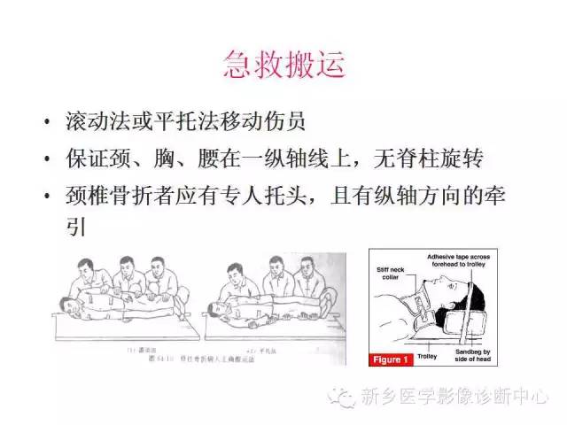 脊柱骨折分型 脊柱骨折分型