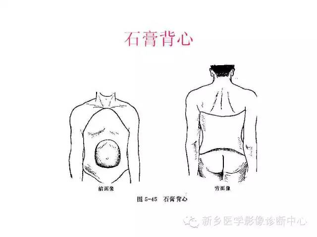 脊柱骨折分型 脊柱骨折分型