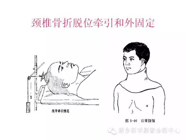 脊柱骨折分型 脊柱骨折分型