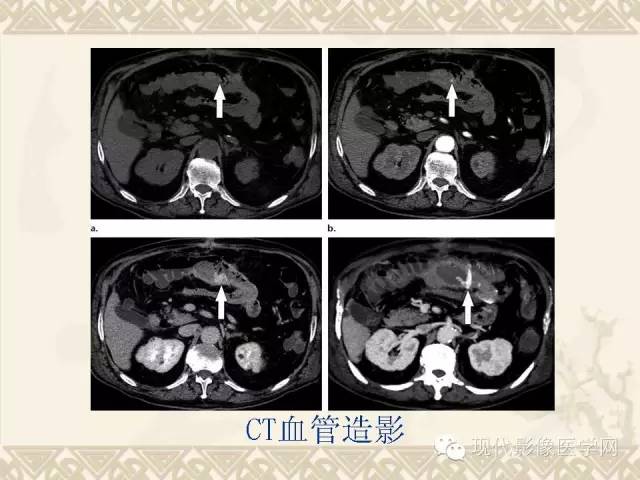 【PPT】腹部肿瘤CT读片小常识