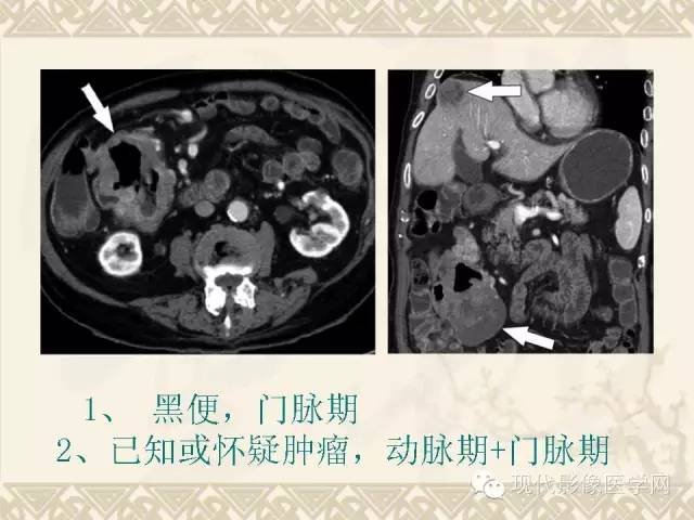 【PPT】腹部肿瘤CT读片小常识