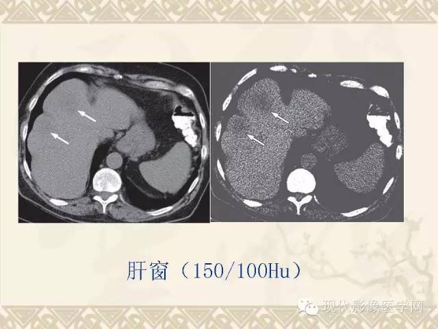 【PPT】腹部肿瘤CT读片小常识