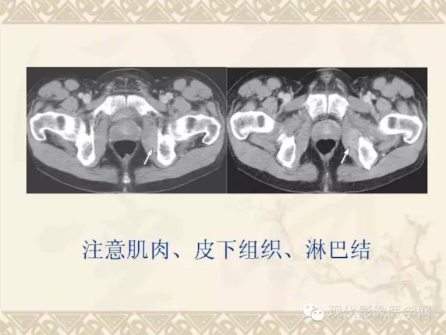 【PPT】腹部肿瘤CT读片小常识