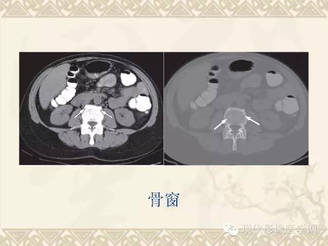 【PPT】腹部肿瘤CT读片小常识