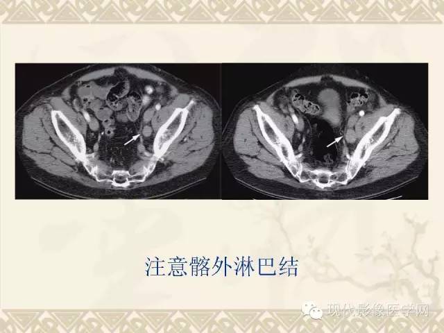 【PPT】腹部肿瘤CT读片小常识