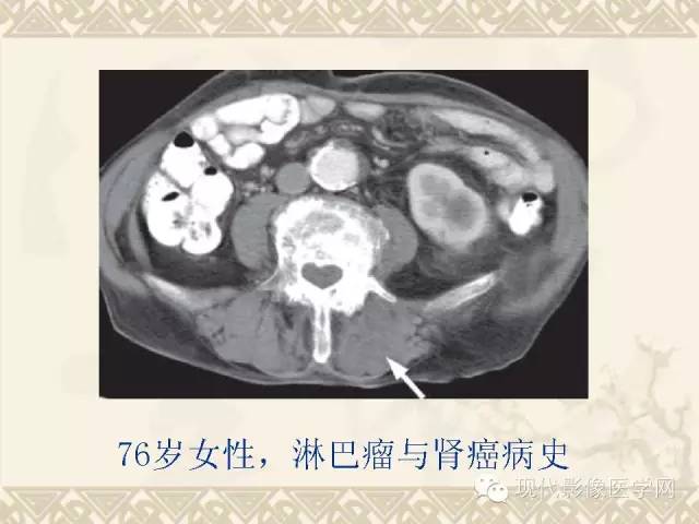 【PPT】腹部肿瘤CT读片小常识