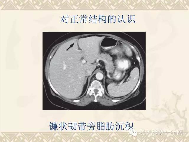 【PPT】腹部肿瘤CT读片小常识
