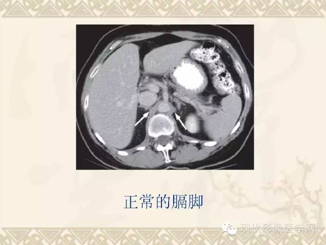 【PPT】腹部肿瘤CT读片小常识