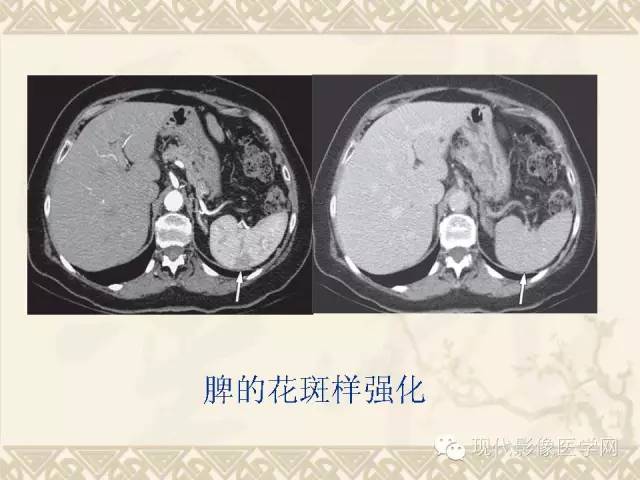 【PPT】腹部肿瘤CT读片小常识