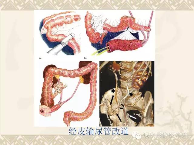 【PPT】腹部肿瘤CT读片小常识