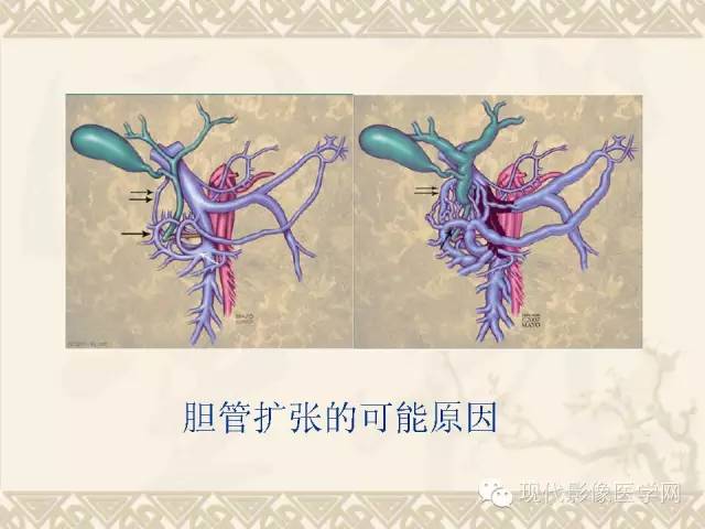 【PPT】腹部肿瘤CT读片小常识