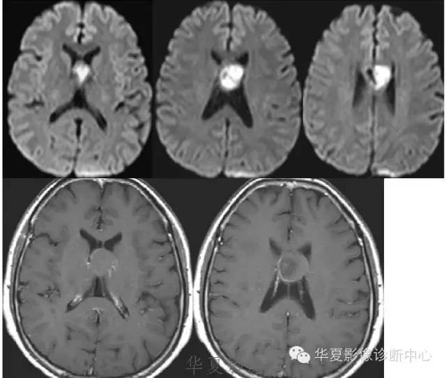 【病例】脑室内表皮样囊肿1例MR影像表现