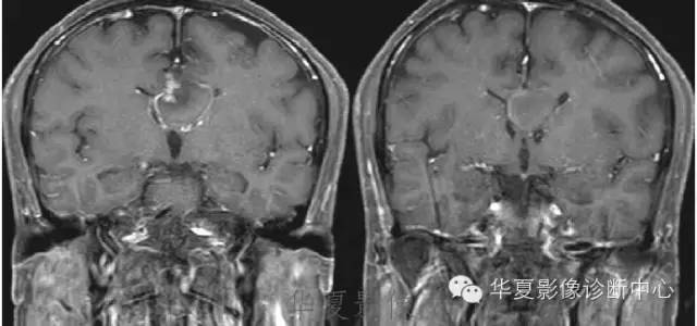 【病例】脑室内表皮样囊肿1例MR影像表现
